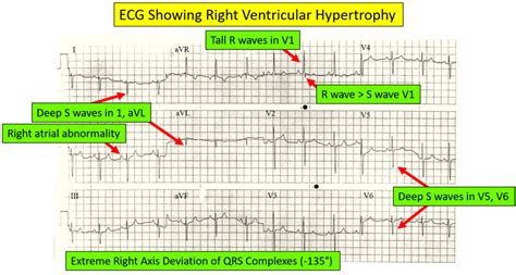 lv hypertrophy ecg criteria